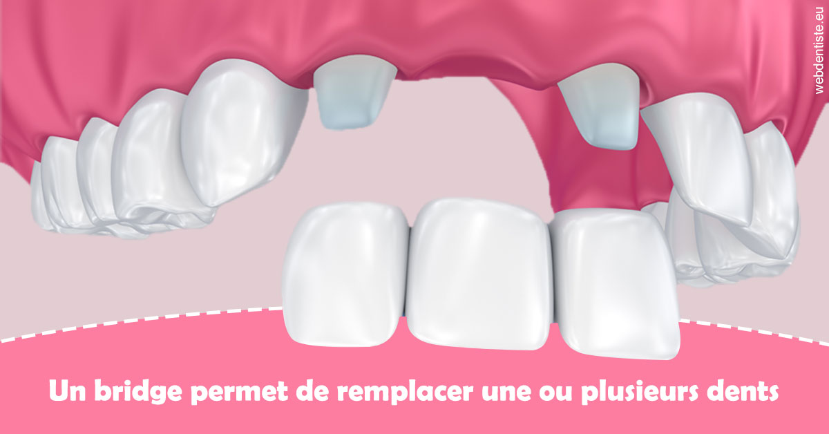 https://dr-yoanna-lumbroso-abtan.chirurgiens-dentistes.fr/Bridge remplacer dents 2