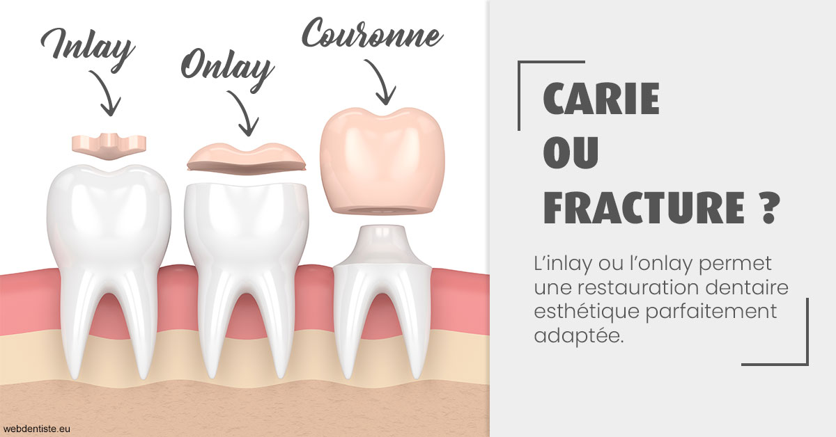 https://dr-yoanna-lumbroso-abtan.chirurgiens-dentistes.fr/T2 2023 - Carie ou fracture 1